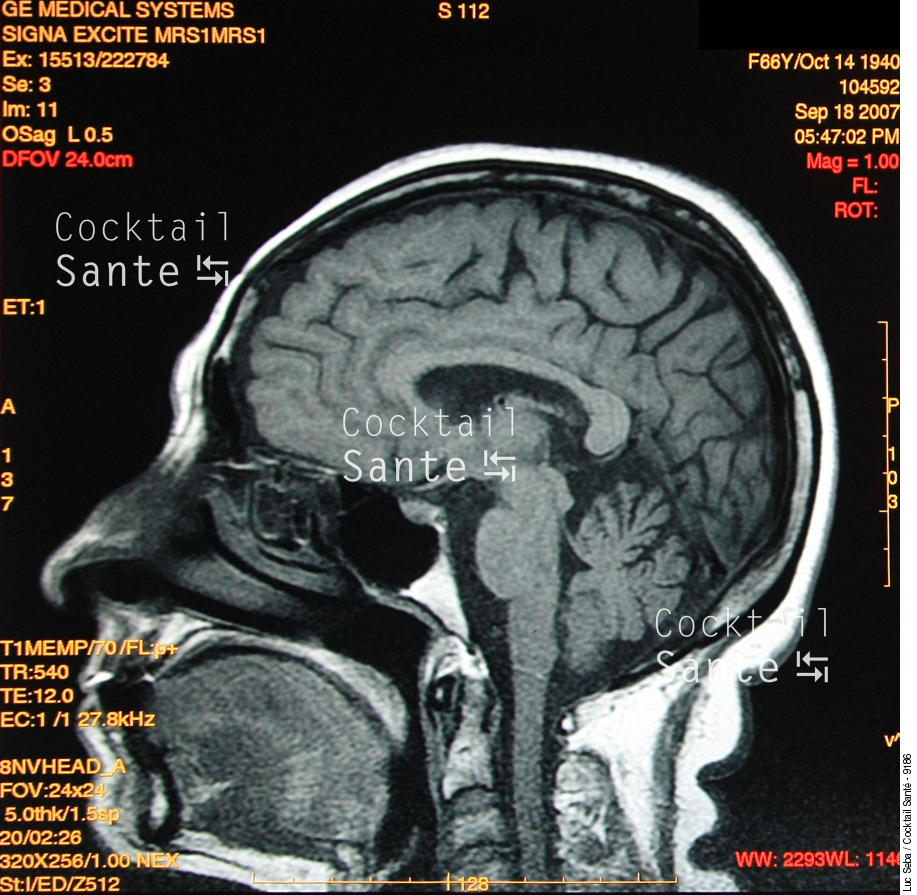 Cerveau-IRM-001-SEBA.JPG