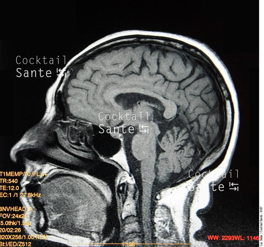 Cerveau-IRM-002-SEBA.JPG