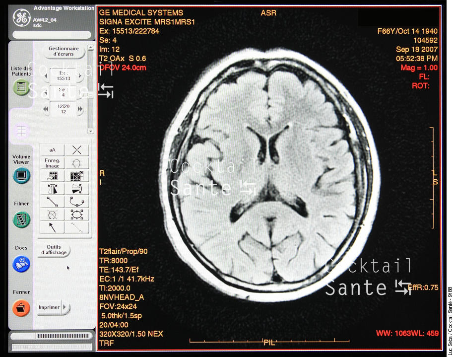 Cerveau-IRM-003-SEBA.JPG
