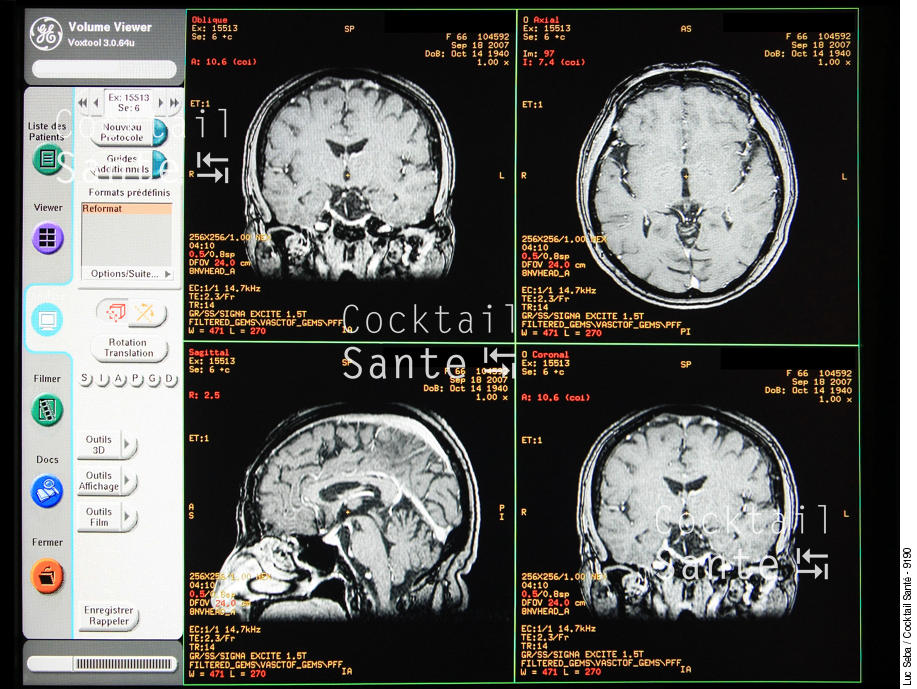 Cerveau-IRM-005-SEBA.JPG
